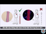 [Video] Bệnh Suy tĩnh mạch